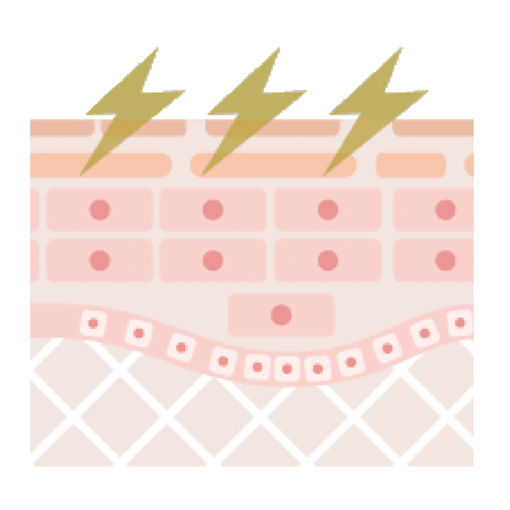 プラズマフェイシャルで肌トラブルにアプローチする施術イメージ(ニキビ)