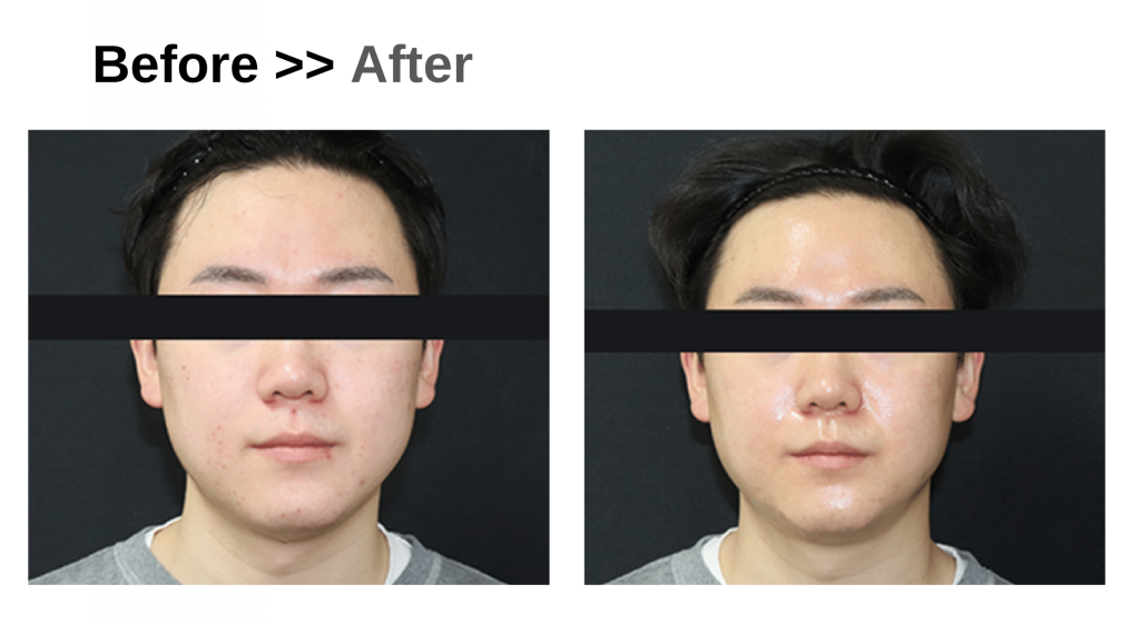 館山メンズピーリング プラピール ビフォーアフター肌荒れ 肌つやの改善の変化の様子