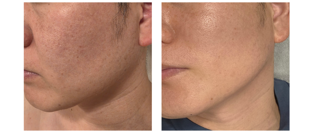 館山メンズピーリング プラピール ビフォーアフター 肌のゴワつきや透明感の変化の様子