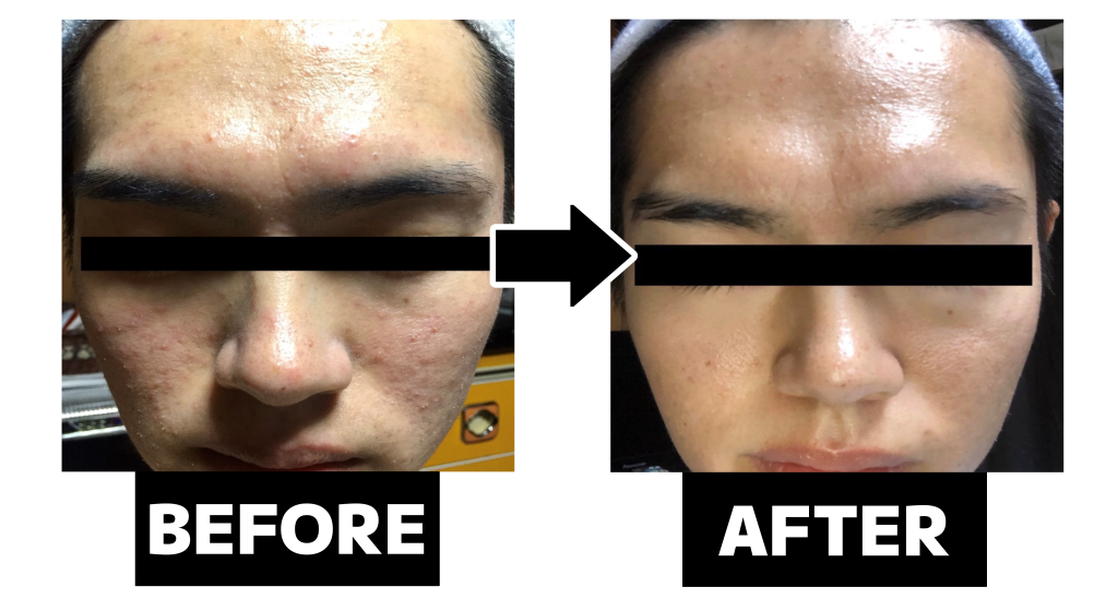 光フェイシャルによるニキビ・肌荒れケアのビフォーアフター(肌状態・見た目の変化)