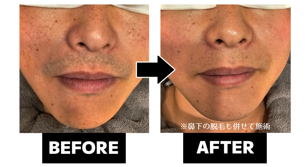 光フェイシャルのシミケア施術前後比較