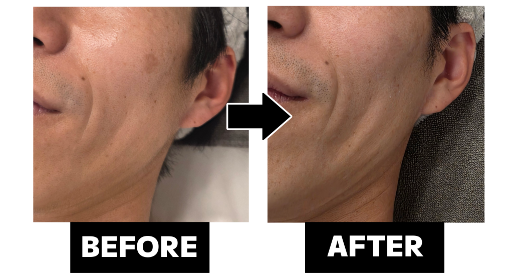 光フェイシャルによるシミケアのビフォーアフター(施術前後の見た目の変化)